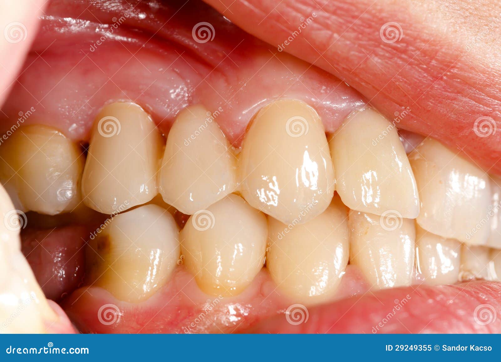 Pressed Ceramic Teeth in Oral Cavity Stock Image Image of prosthesis