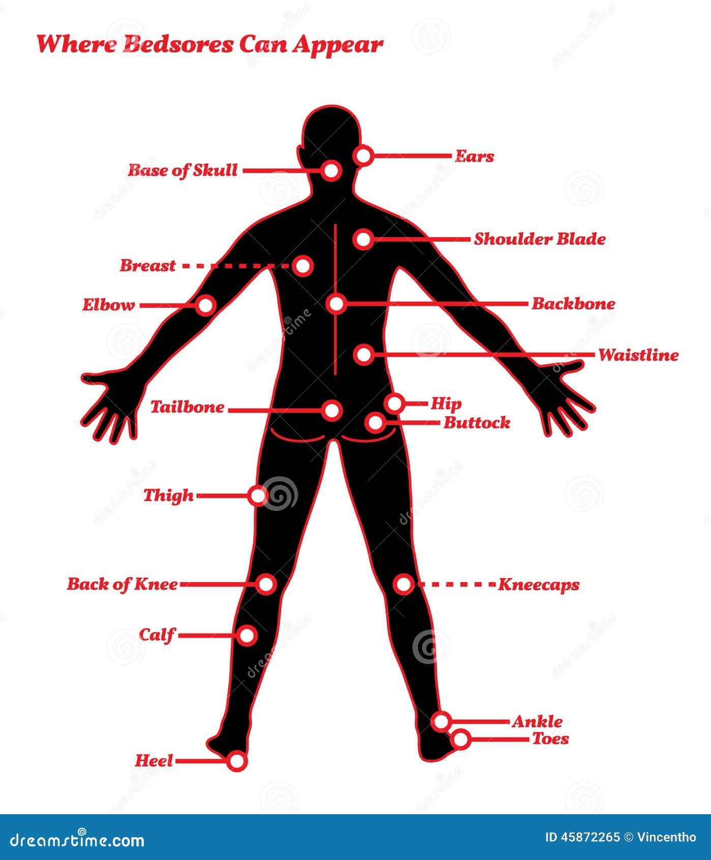 pressure sores bedsores ulcers human anatomy 