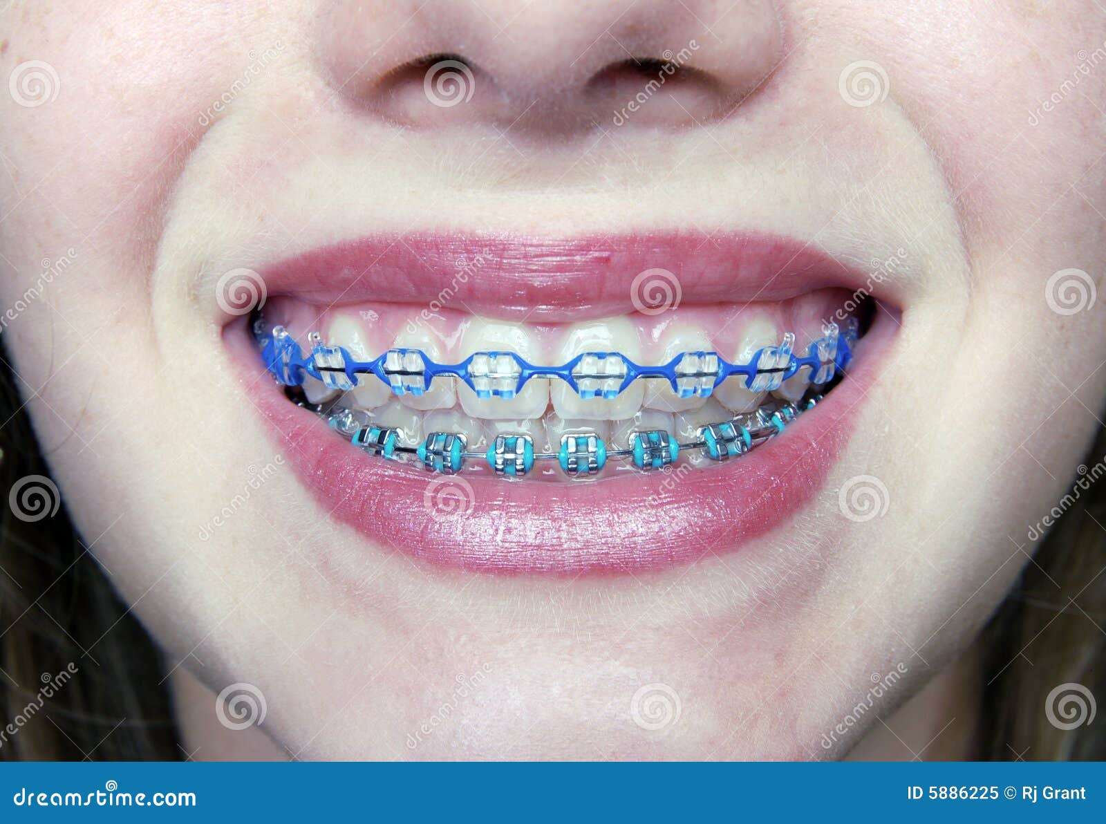 Pretty Smile with Braces stock image. Image of perfect 5886225