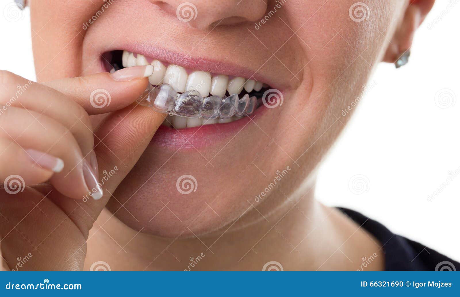 Preventive teeth braces stock photo. Image of mouth, dentist 66321690