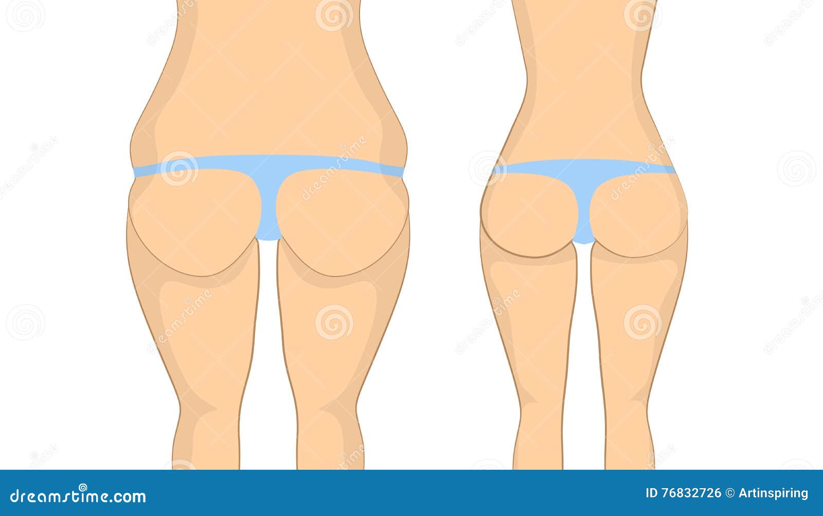 Prima e dopo le natiche illustrazione