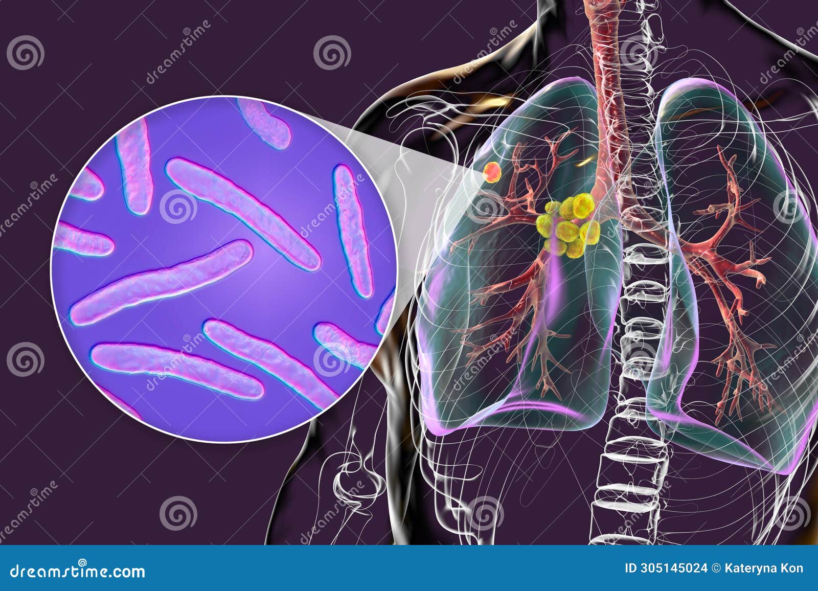 Primary Lung Tuberculosis 3D Illustration CartoonDealer 305145024 primary-lung-tuberculosis-3d-illustration-cartoondealer-305145024