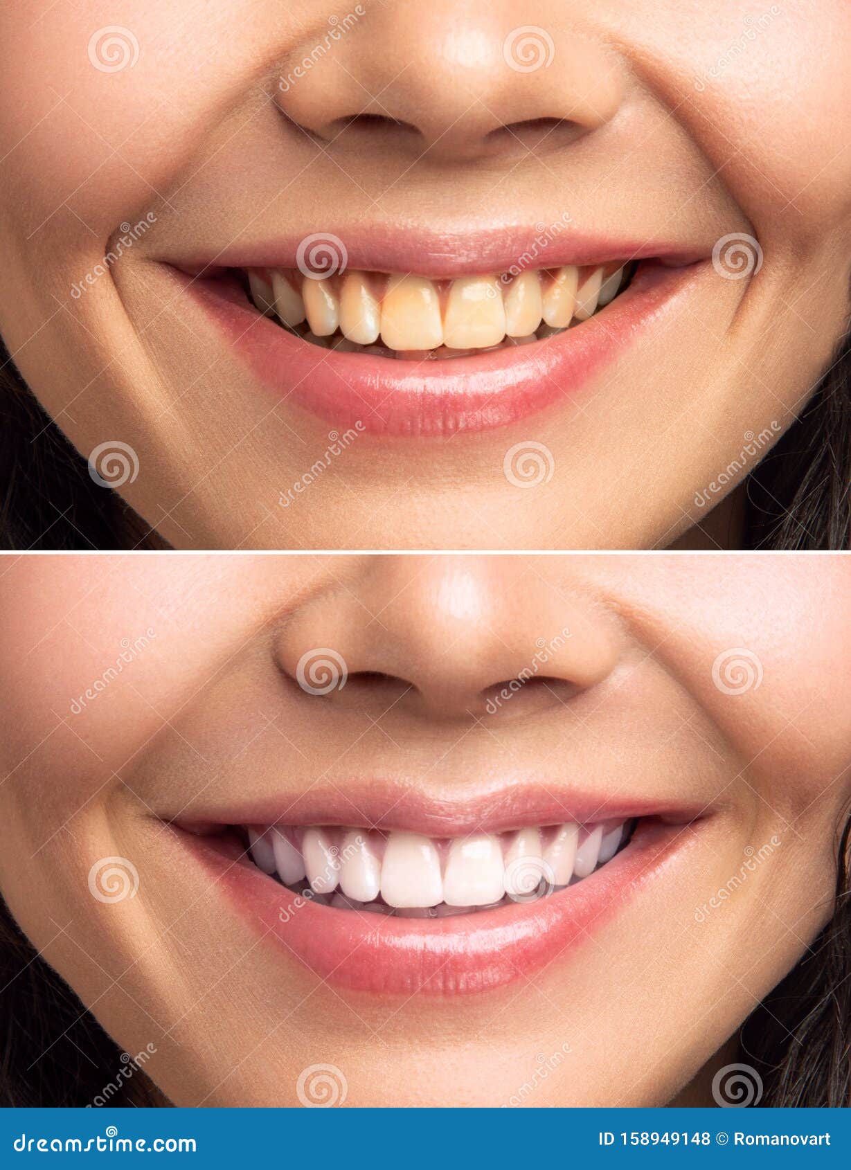 Primer Plano De La Mujer Sonriente Dientes Antes Y Después Del ...