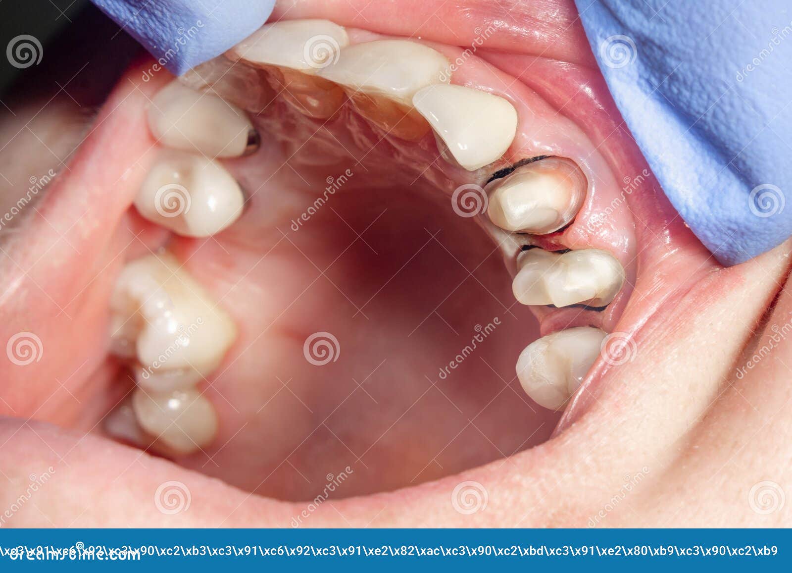 Quanto Costa Mettere Un Dente Fisso Con Perno Primo Piano Dentario Del Perno, Preparazione Del Dente Per Il