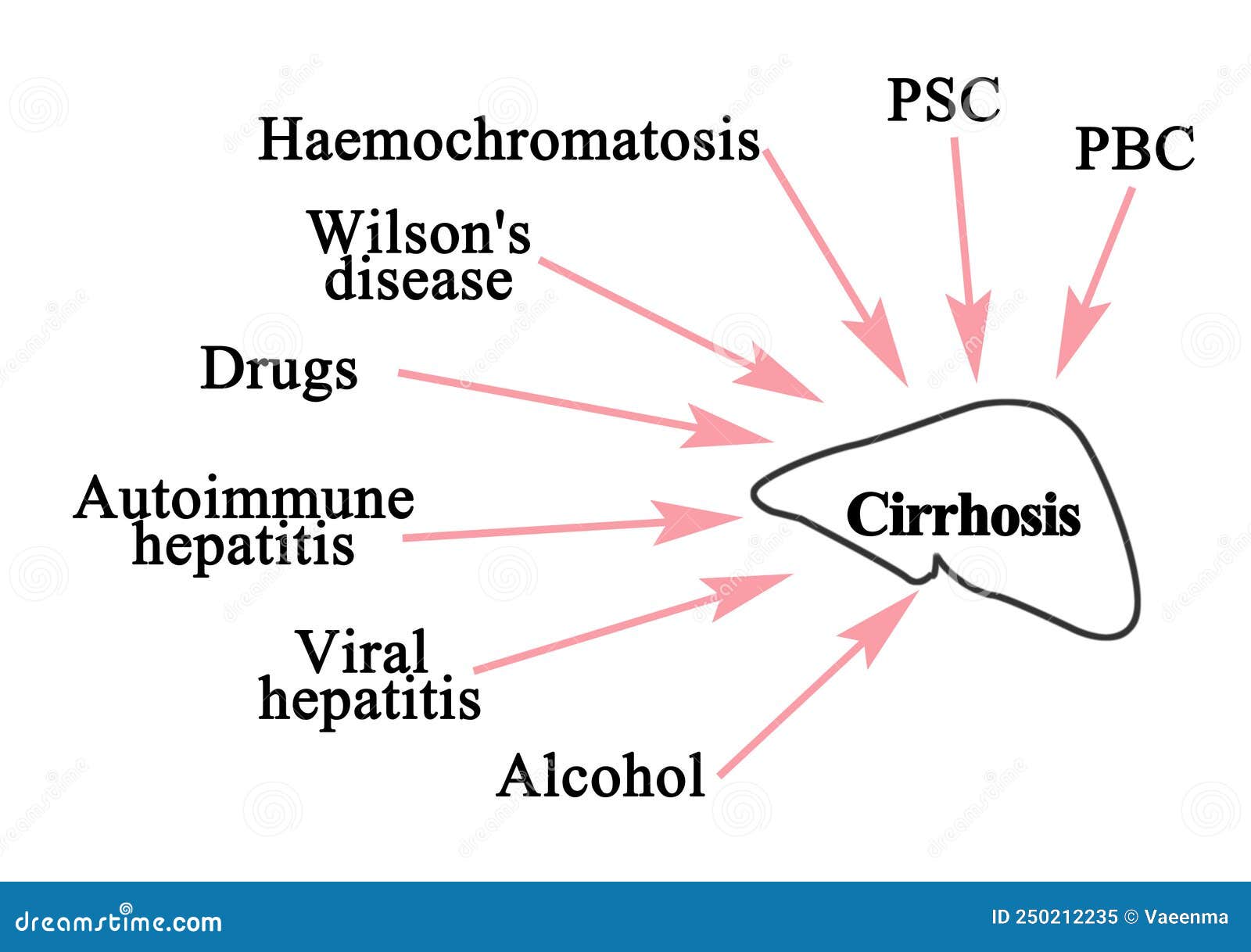 Principales Causas De Cirrosis Imagen de archivo Imagen de wilson