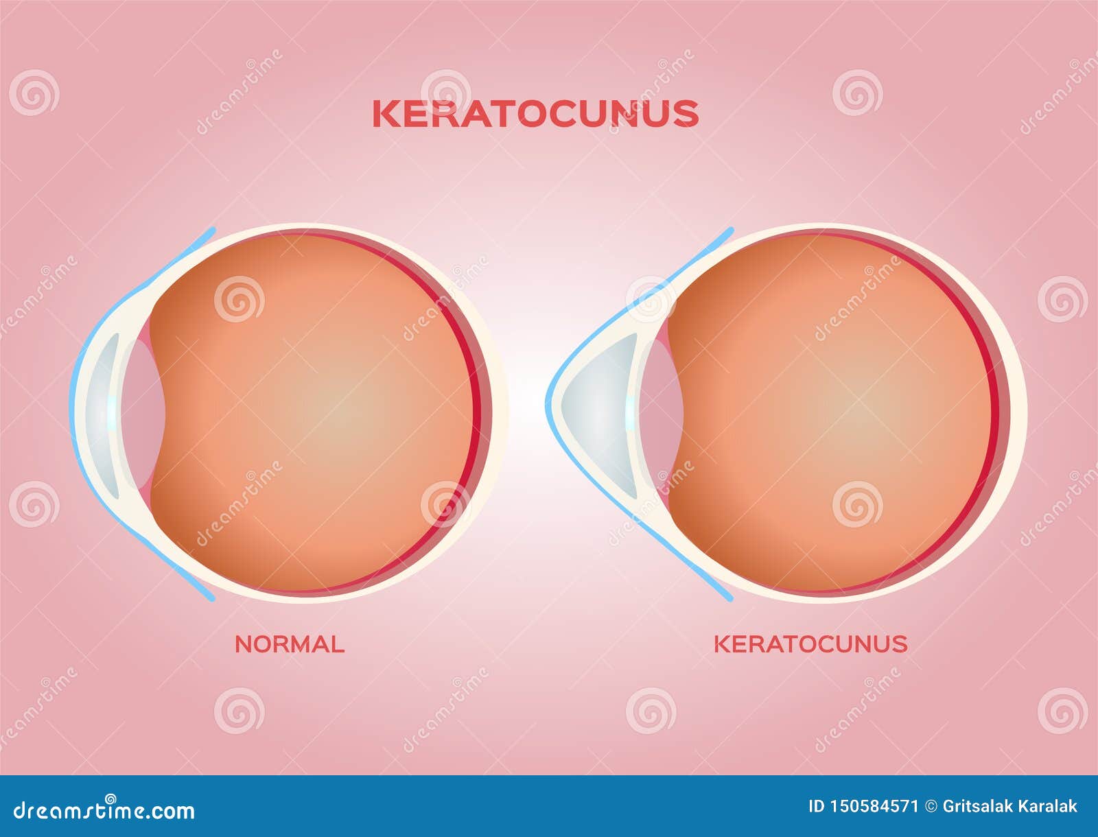 eye cornea and keratoconus  / anatomy