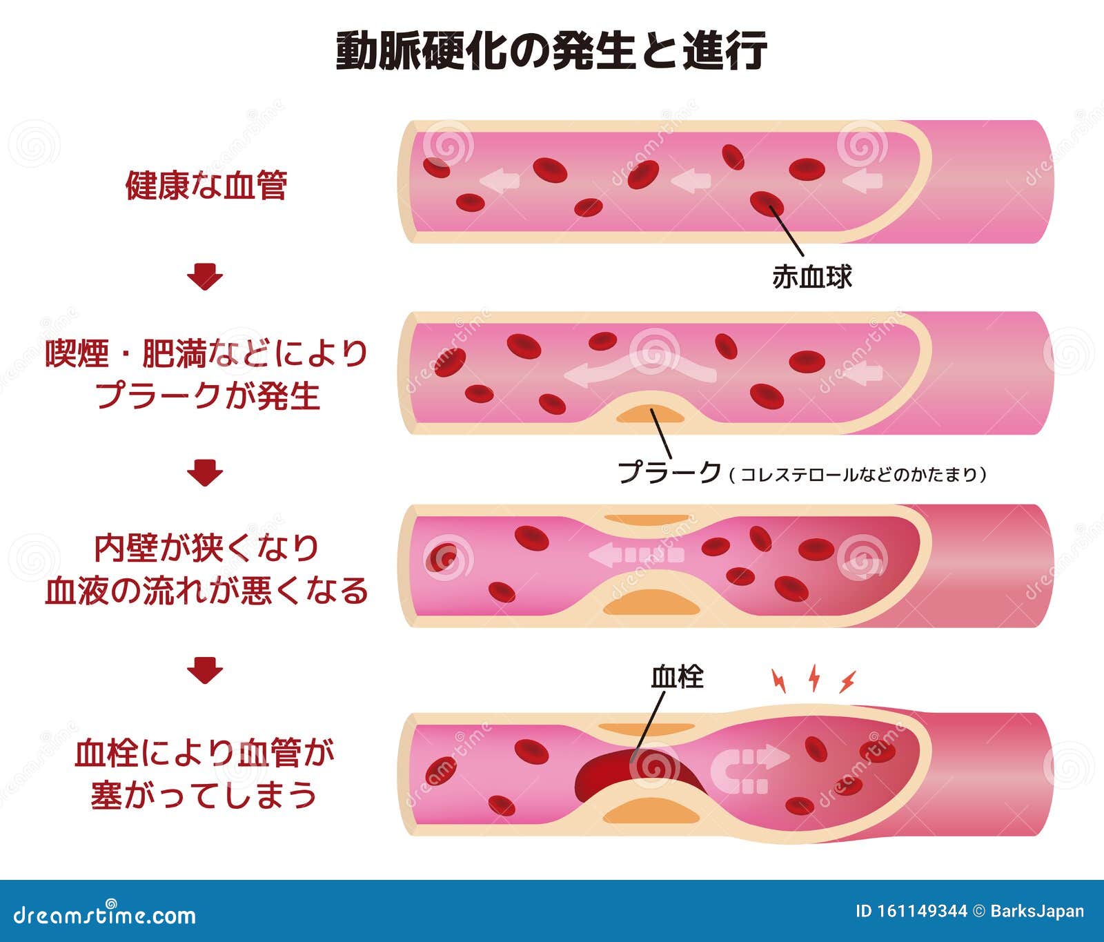 progression-of-arteriosclerosis-illustration-stock-vector