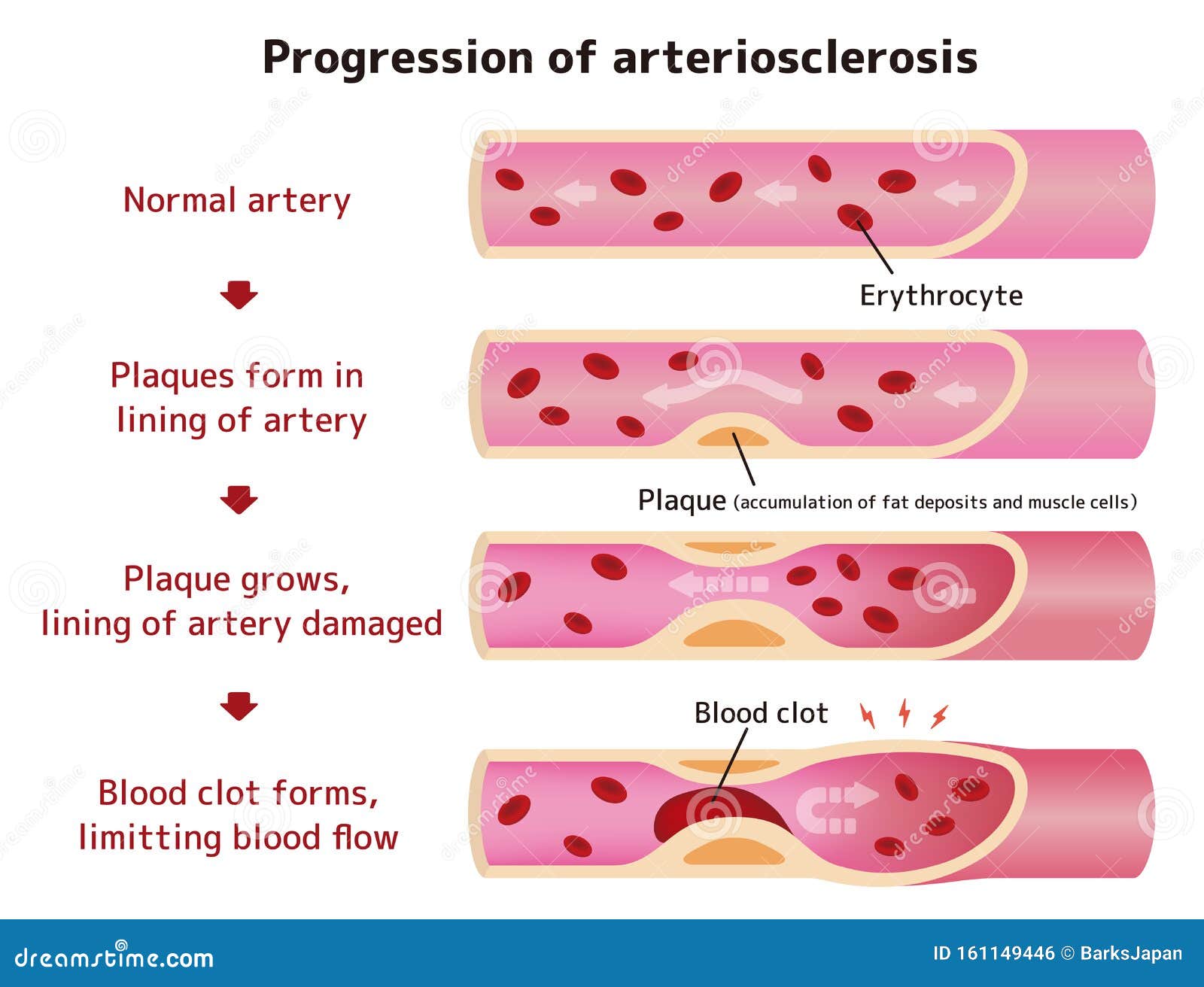 Progression of Arteriosclerosis Illustration Stock Vector