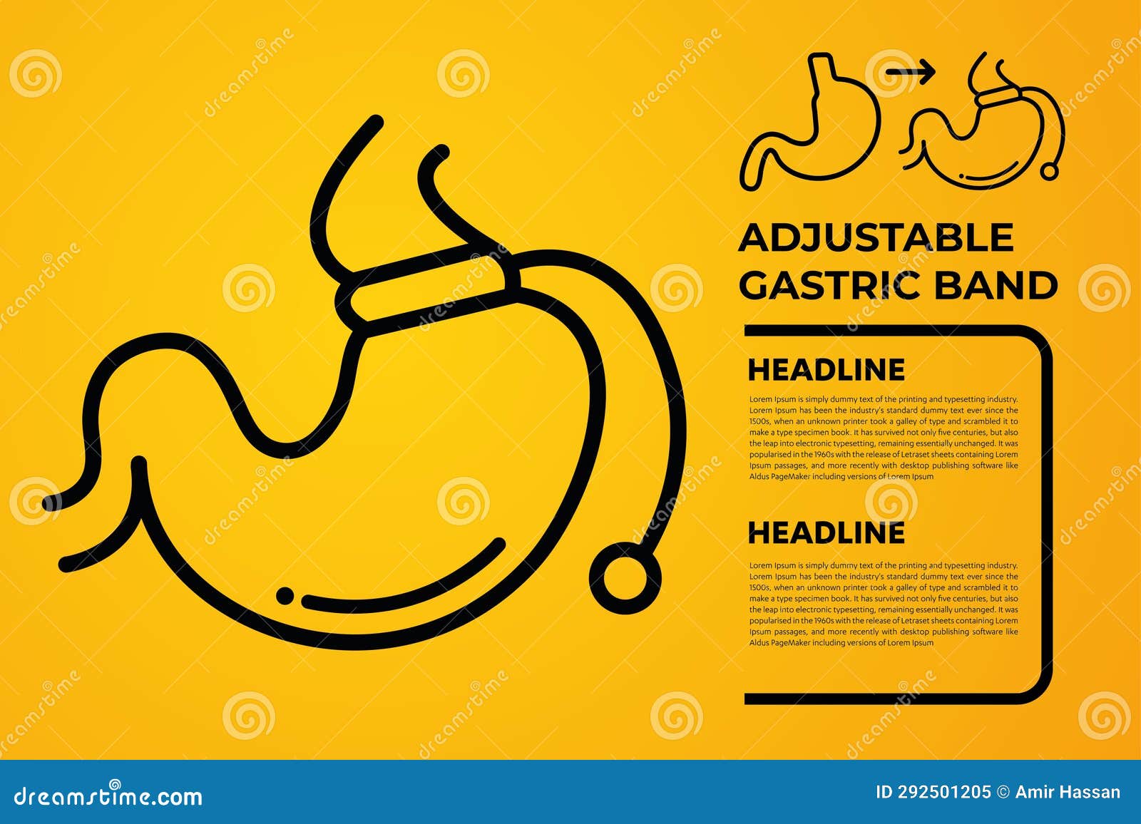 Illustration of Adjustable Gastric Band Devise Weight Loss Surgery Vector Stock Vector
