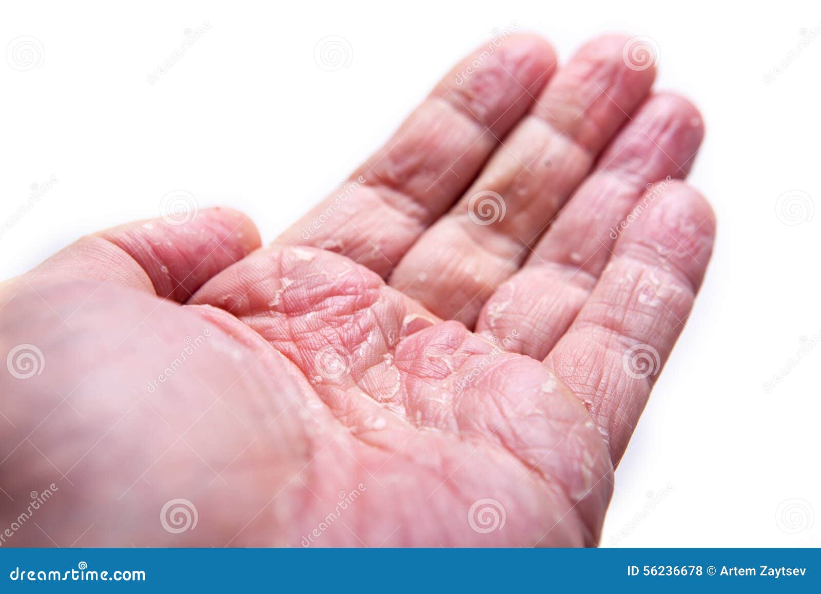 Hand Eczema On Black Leather With Copy Space Stock Image