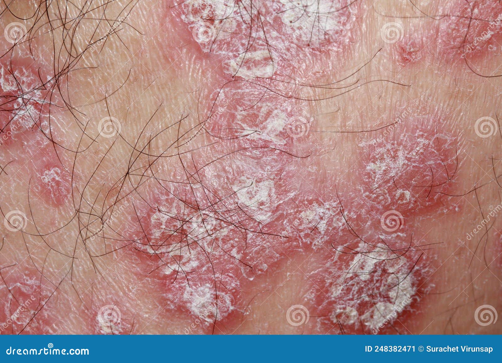 Psoriasis is an Autoimmune Disease that Affects the Skin Causing Red