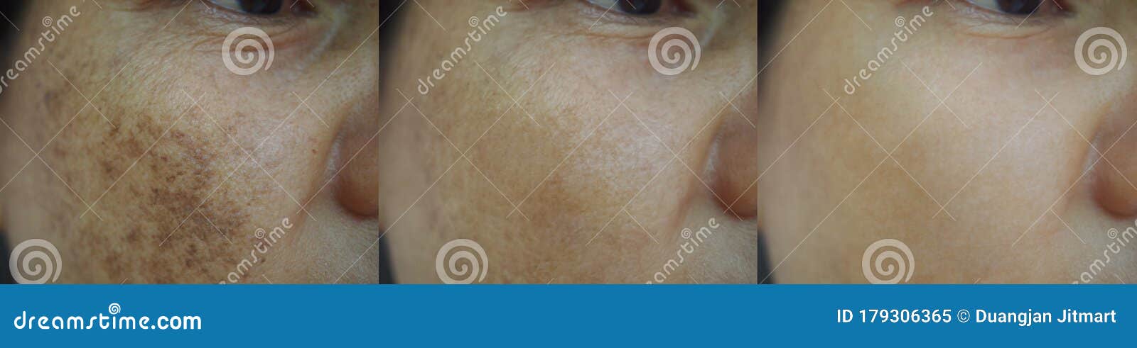before and after spot melasma treatment
