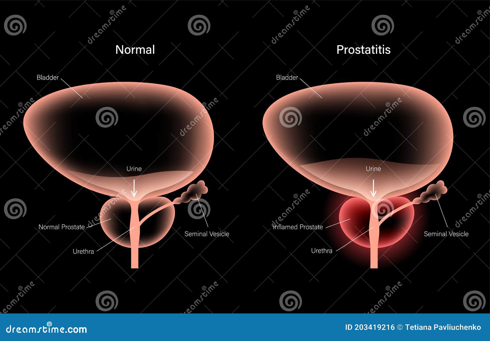 a prostatitis oldalán fájó