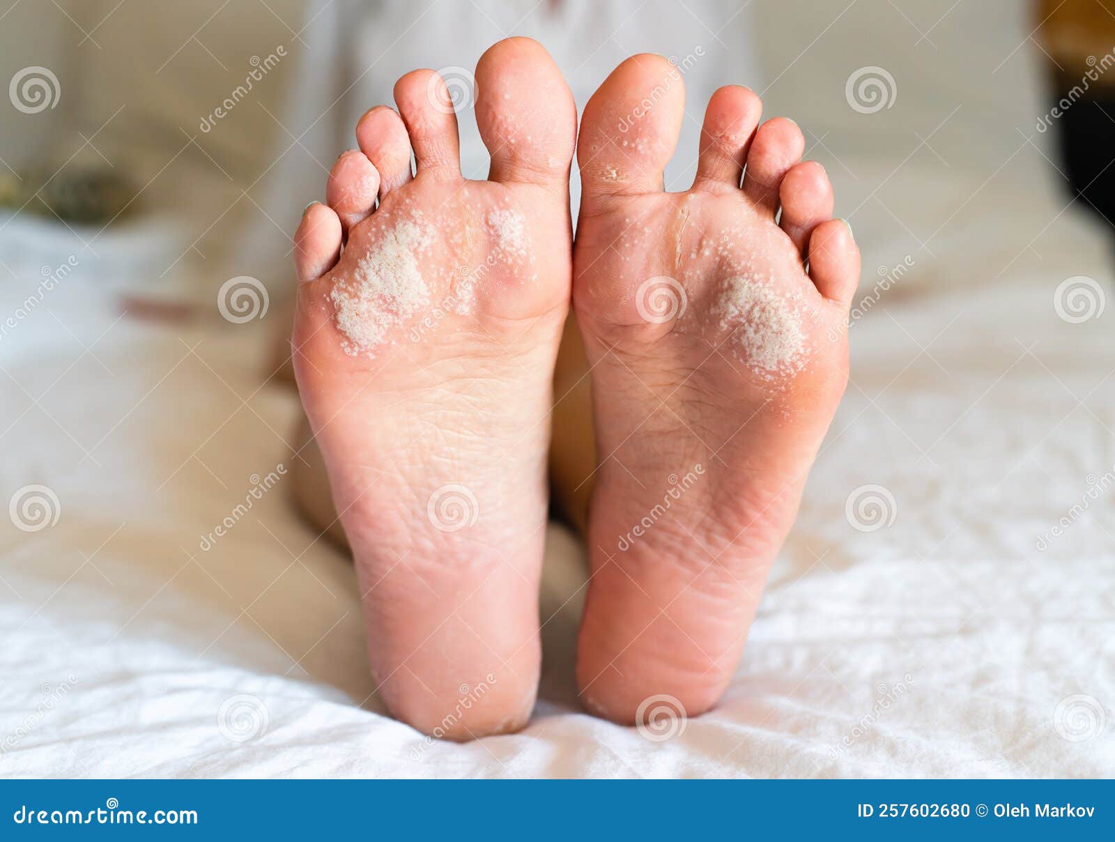 Problems with the Skin of the Feet. Dermatological Diseases Stock Photo