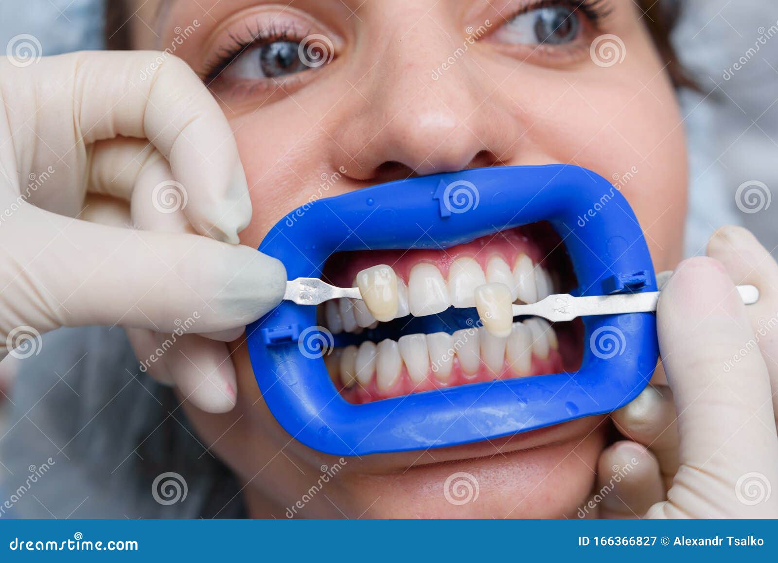 Procedure for Comparing the Color Shades of Teeth with Tests after