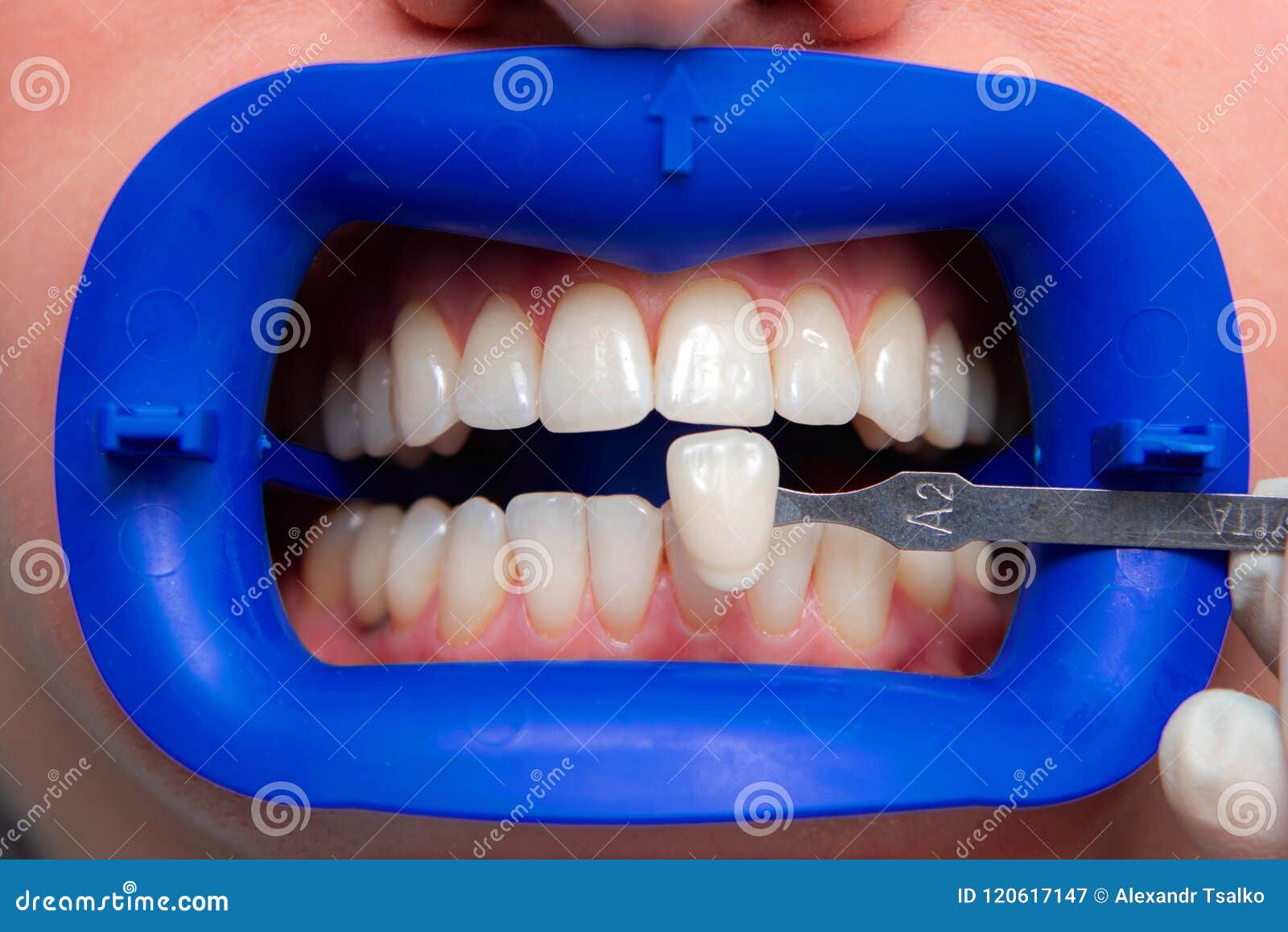 Procedure for Comparing the Color Shades of Teeth Using Tests before