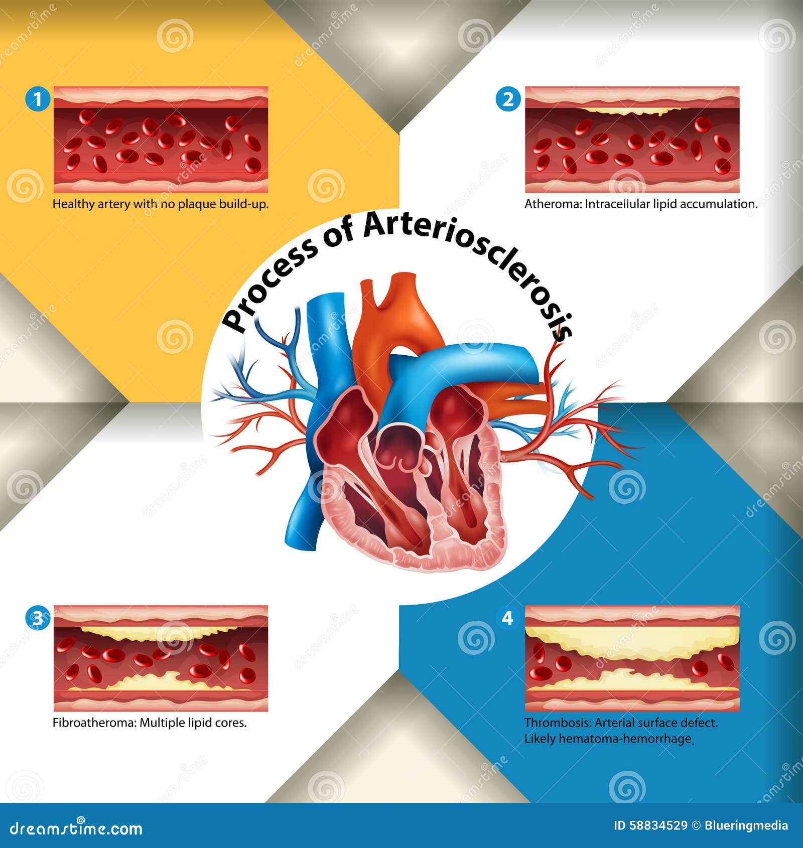 Process of Arteriosclerosis Poster Stock Vector Illustration of