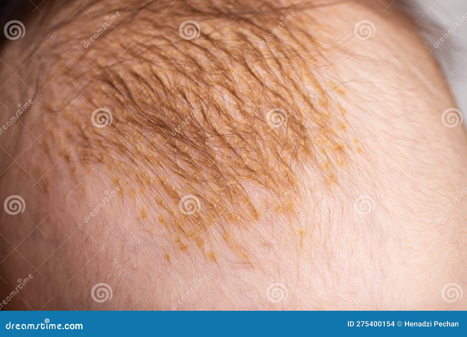 The Process of Formation of Seborrheic Dermatitis in an Infant on the