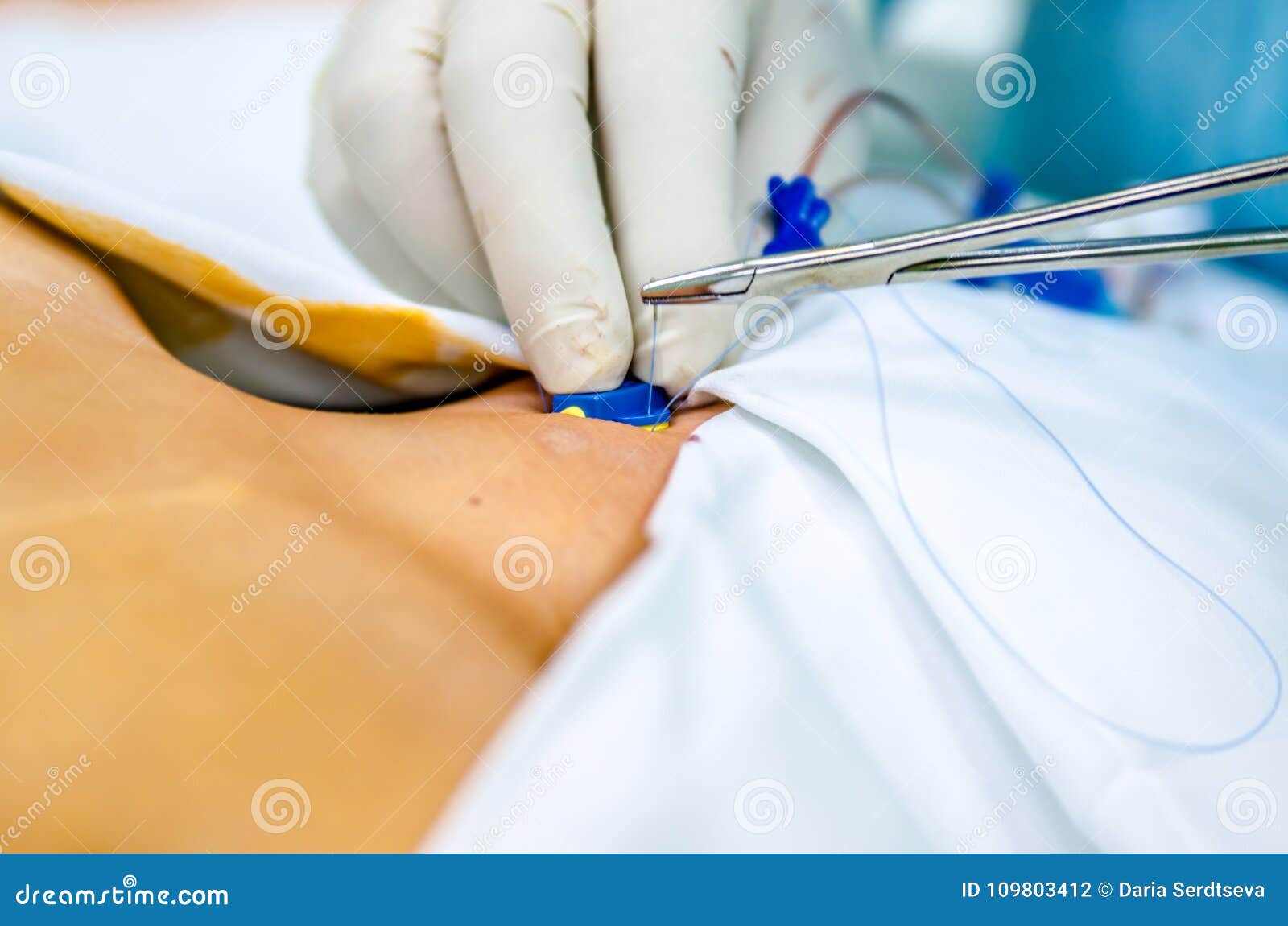 The Process of Installing an Anesthetist at the Central Catheter. Stock