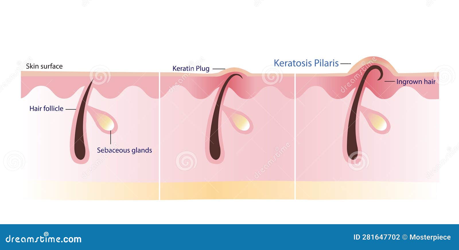 The Process of Keratosis Pilaris Vector Illustration Isolated on White