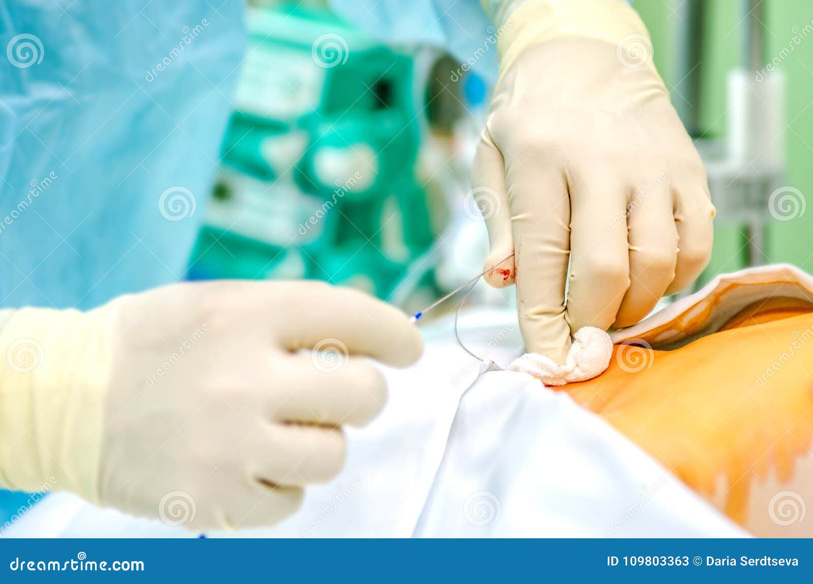 The Process of Setting the Central Catheter before the Operation. Stock