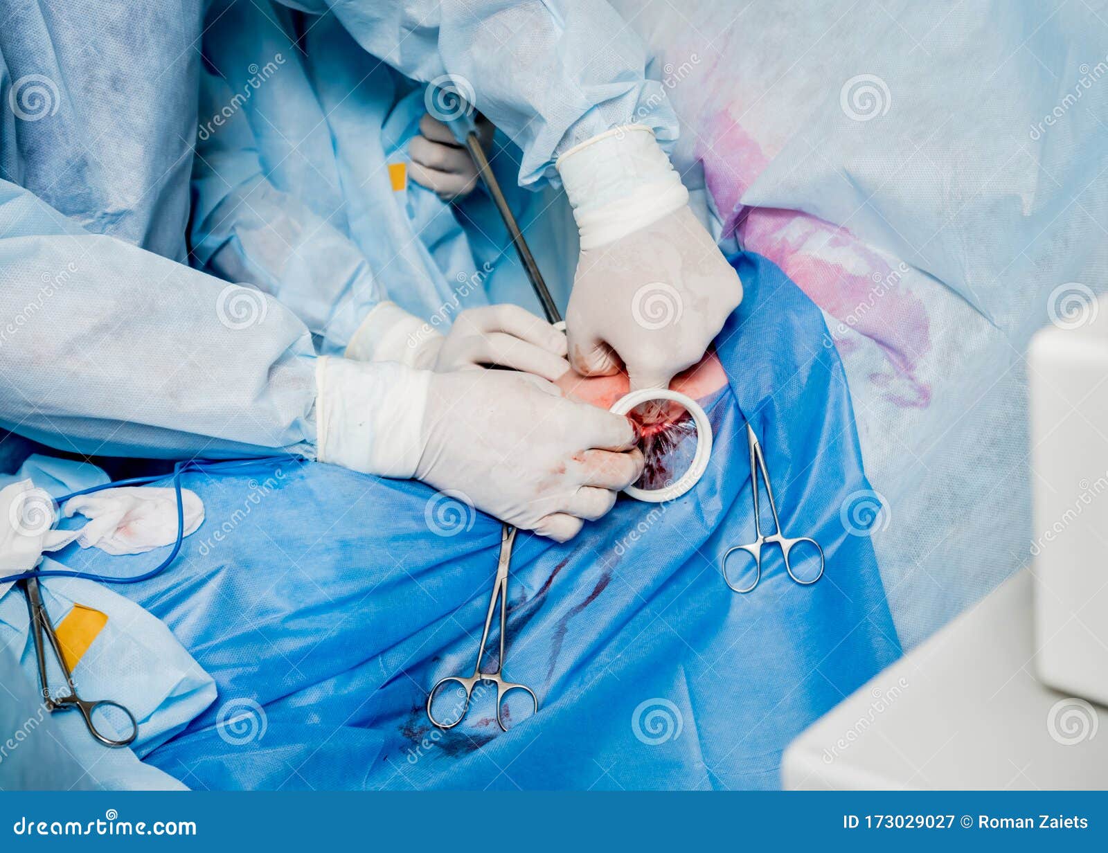 Process of Surgery Operation Using Laparoscopic Equipment. Stock Image Image of operation