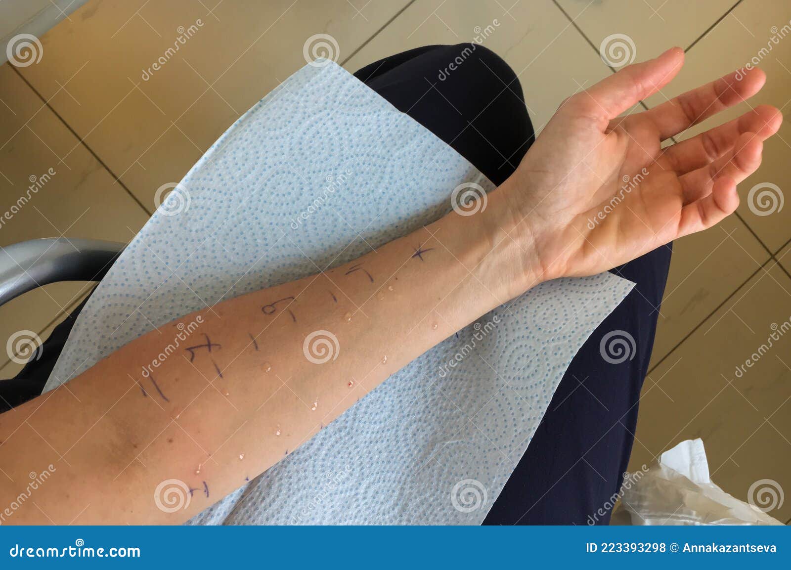 Processus De Test De La Peau Allergique Sur La Main Du Patient Photo