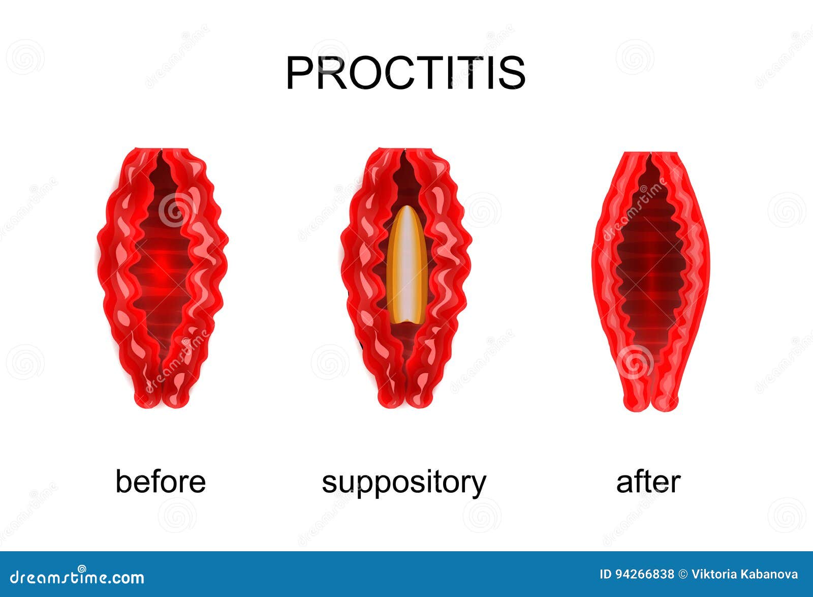 Before And After Treatment Of Rectal Suppositories Stock, 59% OFF