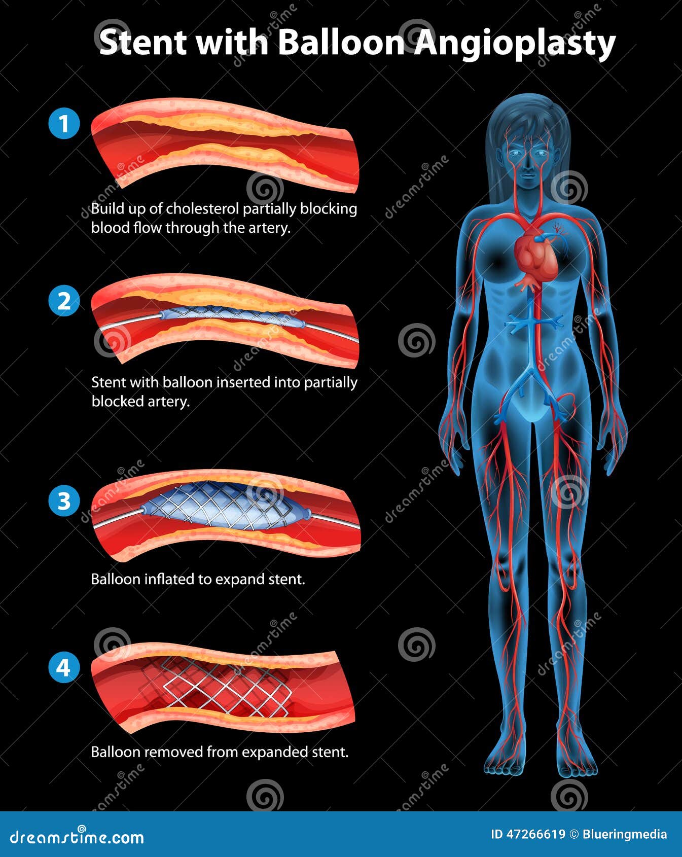 Thrombose après pose de stent