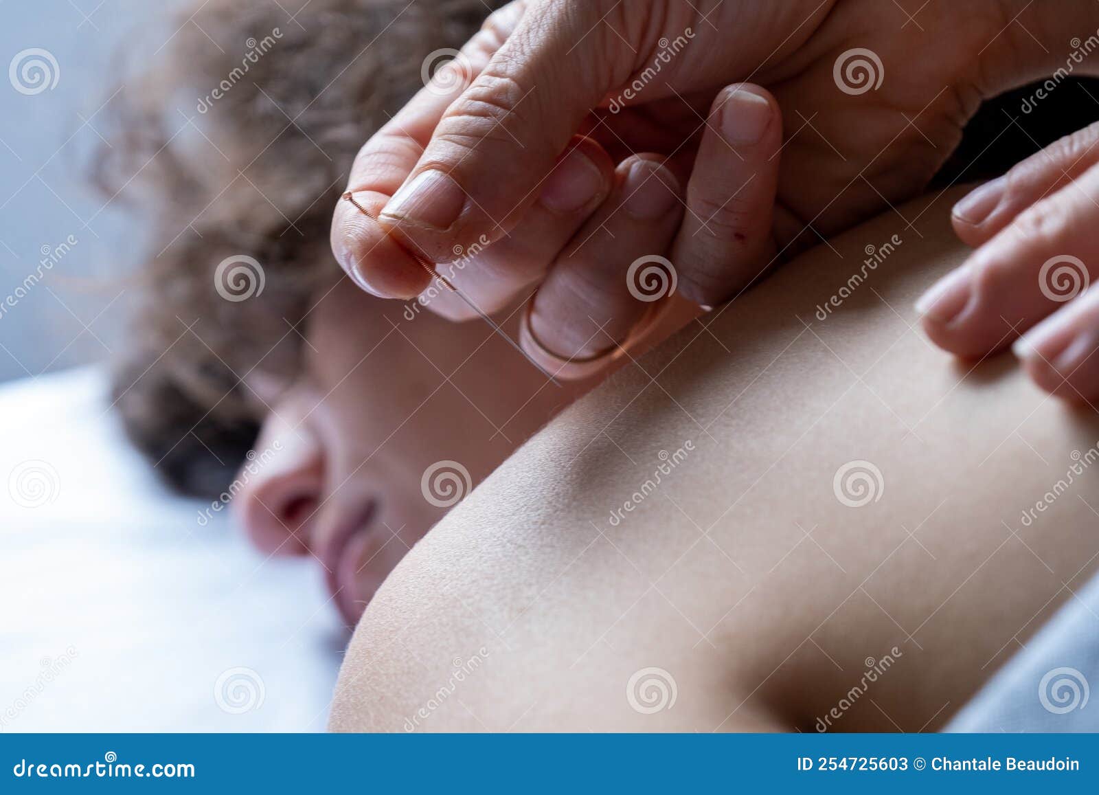 profesional woman giving acupuncture treatment