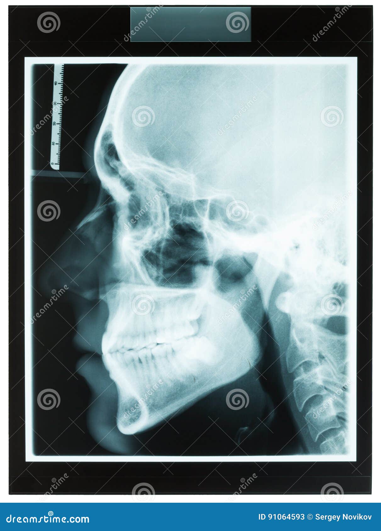 profile xray of man jaw for dentist