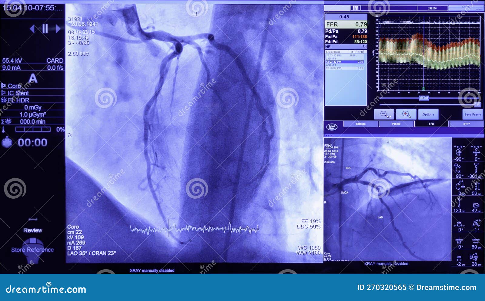 Projection of Veins on the Screen in Heart Surgery, Transcatheter