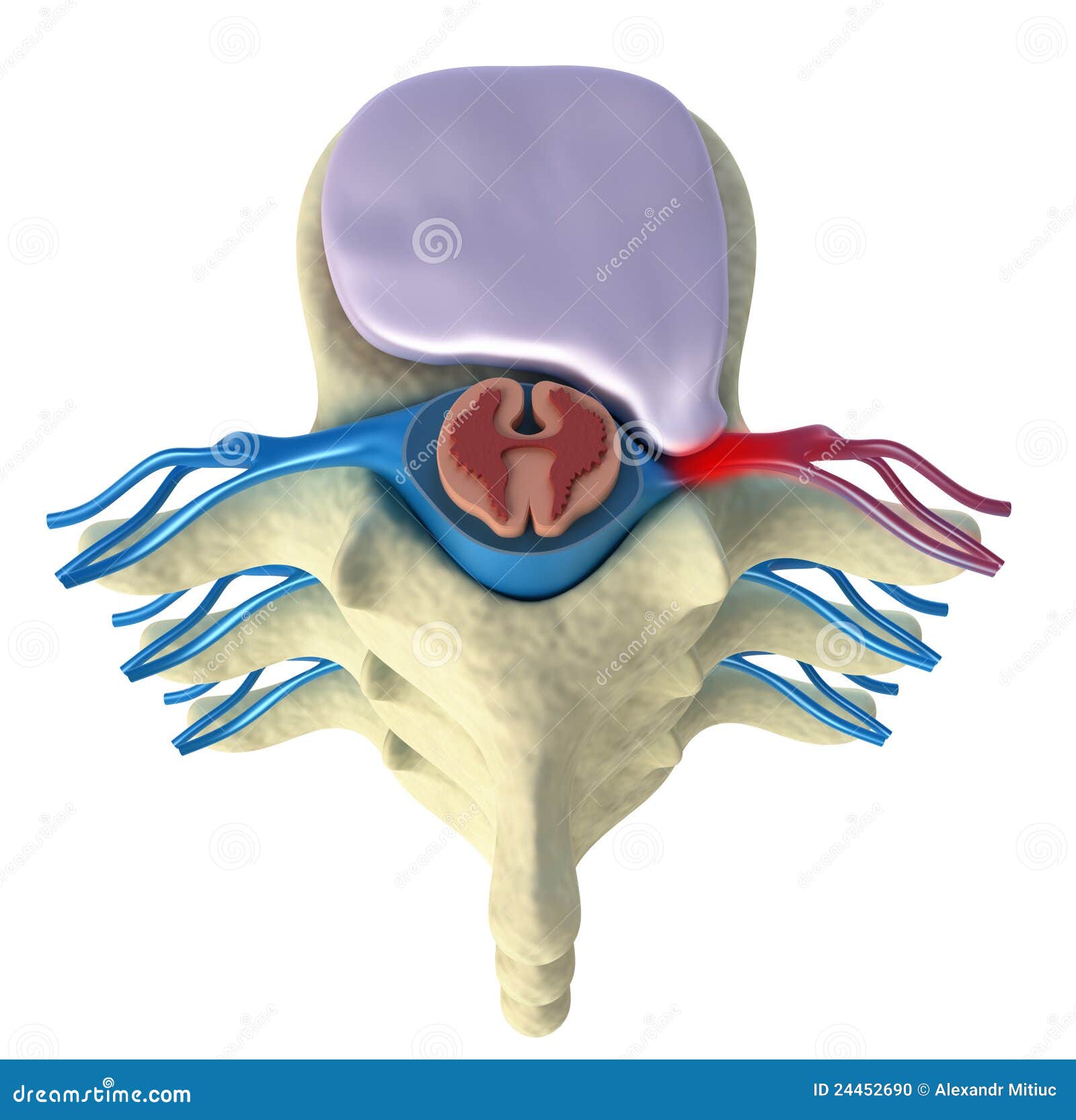 Prolapse of Intervertebral Disc Stock Illustration Illustration of