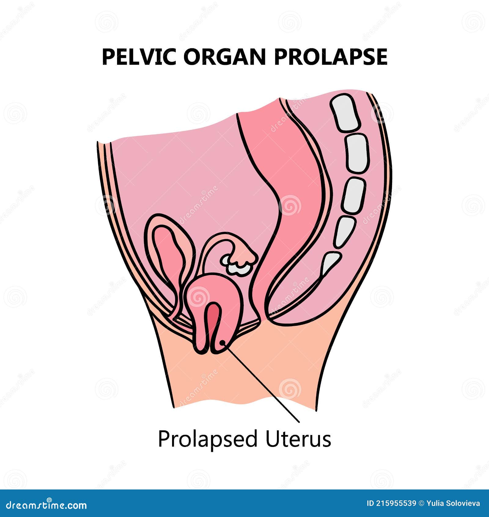 PROLAPSED UTERUS of Women Medical Education Scheme Vector Set