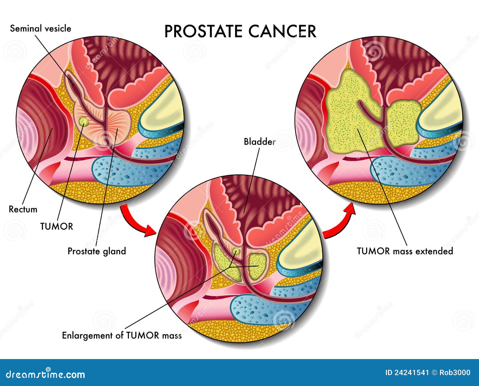 prostate cancer