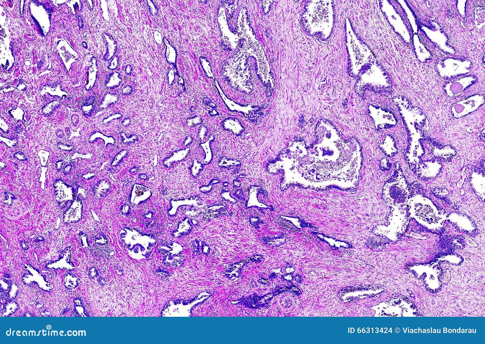 prostate cancer of a human