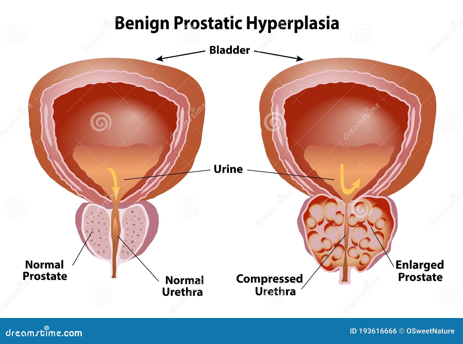 neoplasia prostata benigna prostata cum se vindeca