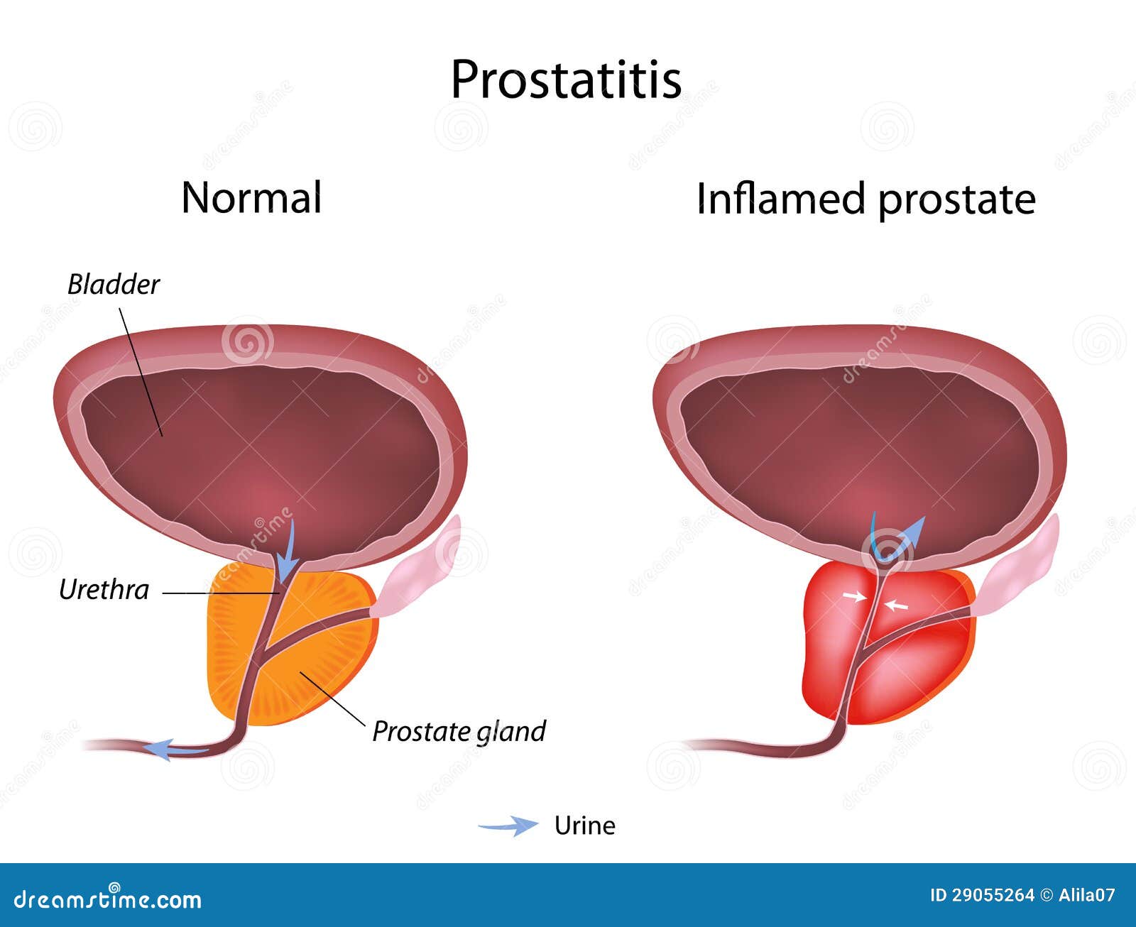 prostatitis remisszióban)
