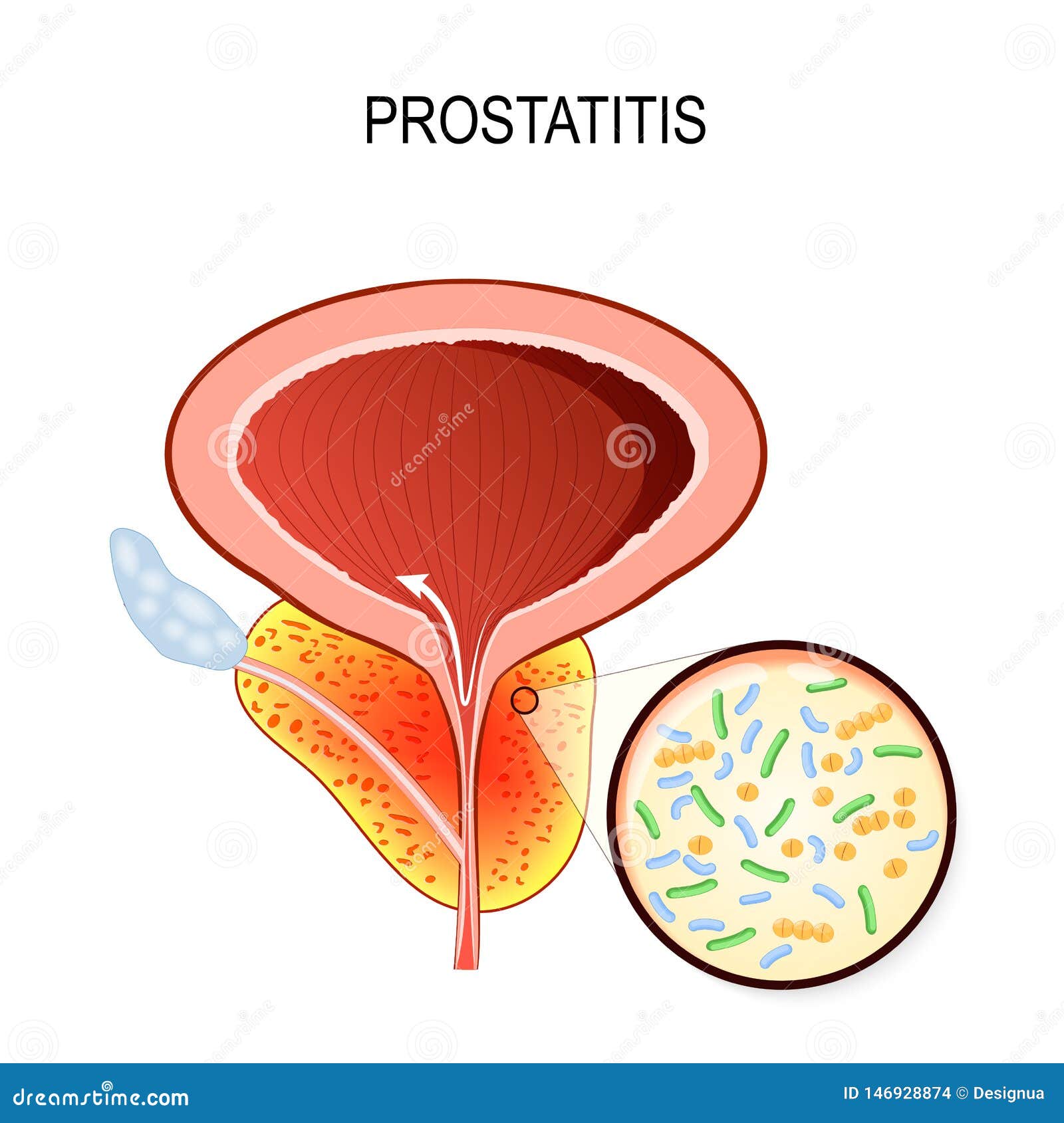 prostatitis. close-up of bacteria that cause inflammation: escherichia coli, pseudomonas aeruginosa and enterococcus