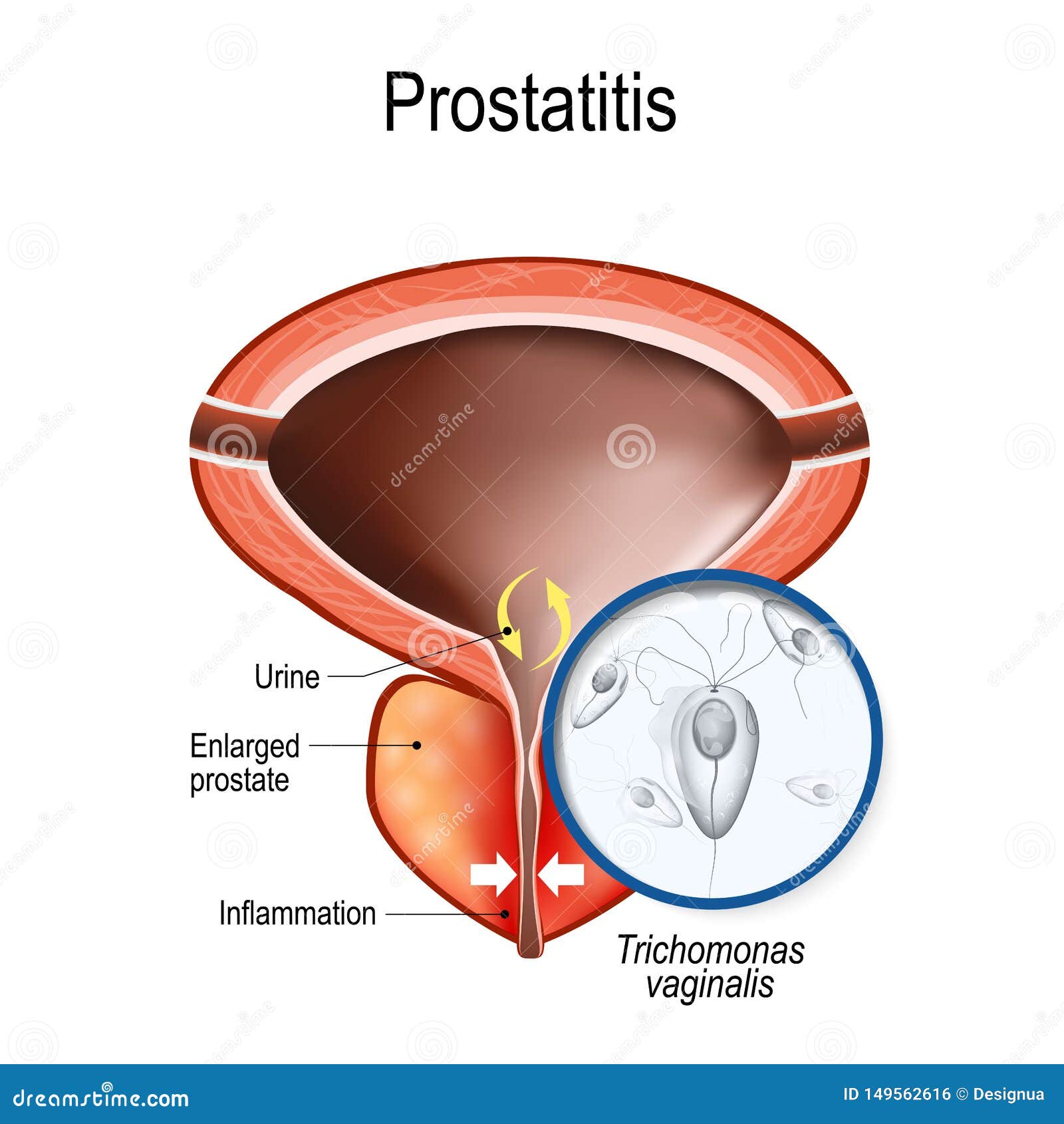 prostatitis trichomoniasis a prosztatitisben vízzel öntözhet