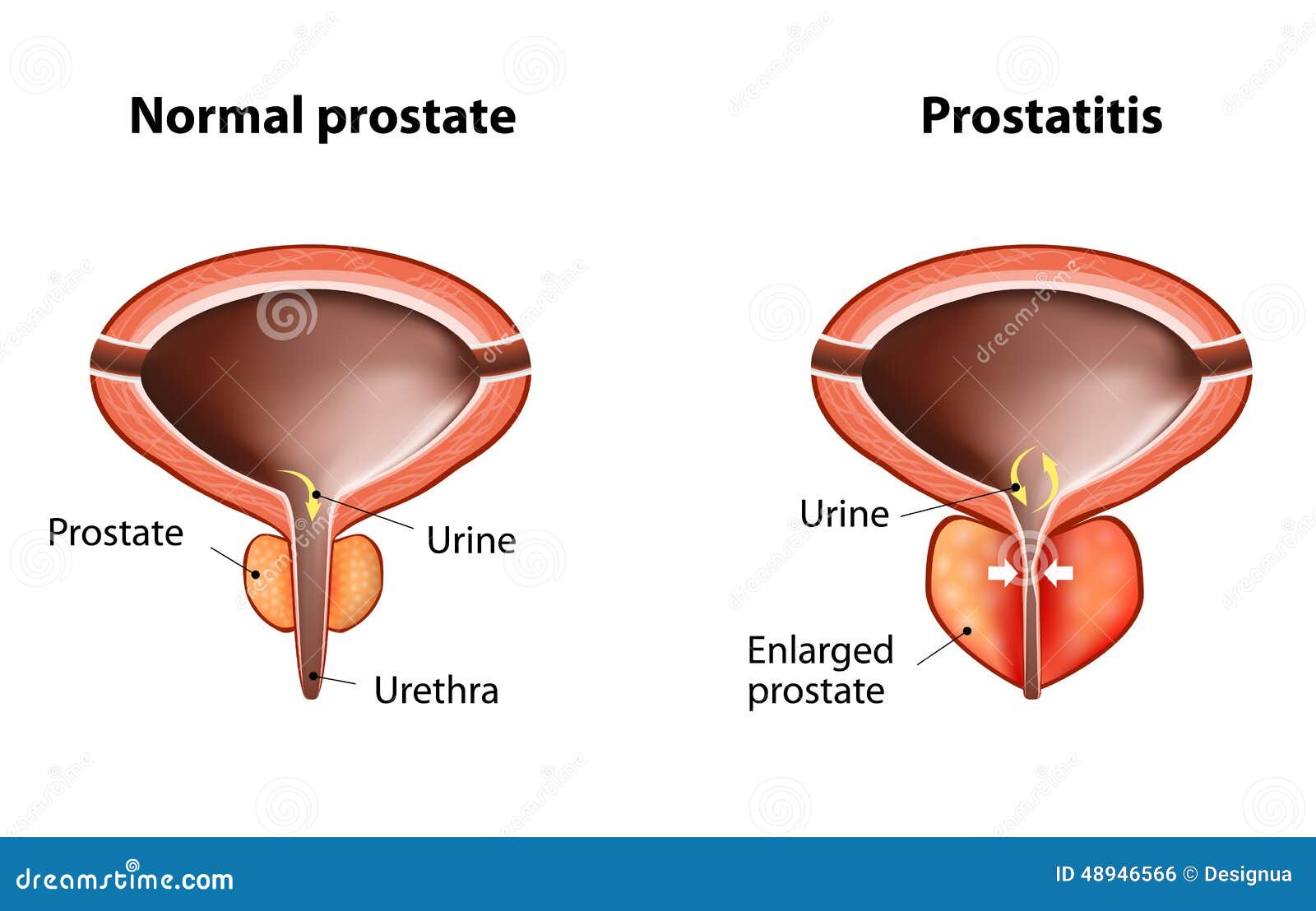 prostatite acuta prostata