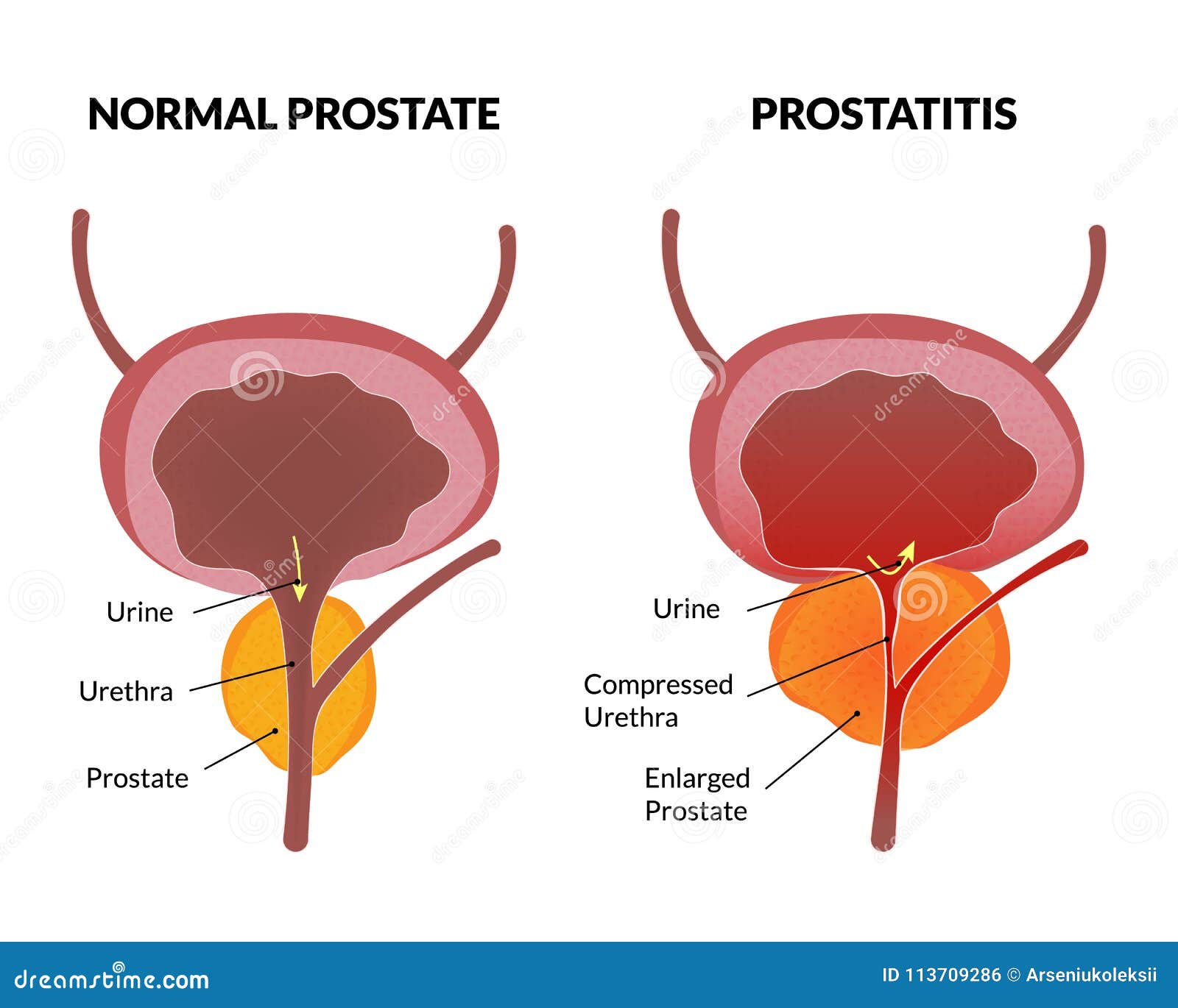 acute prostatitis and prostate cancer)