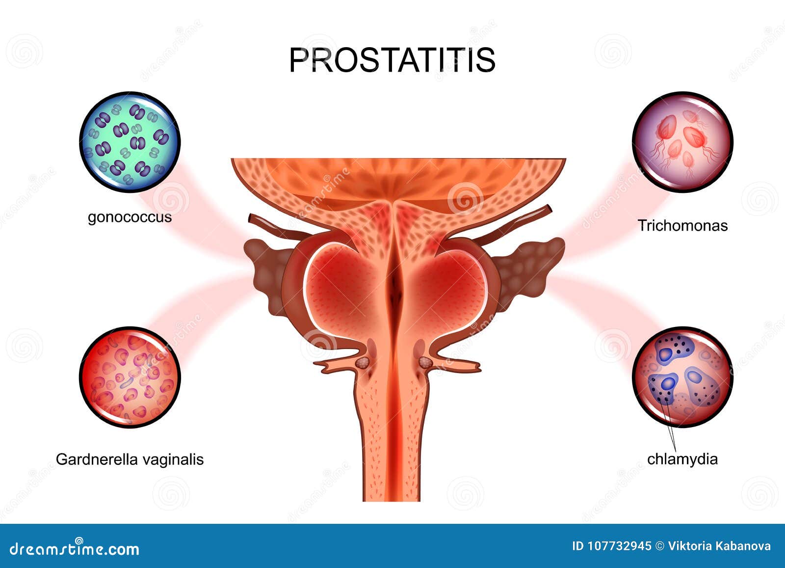 candida prostatitis