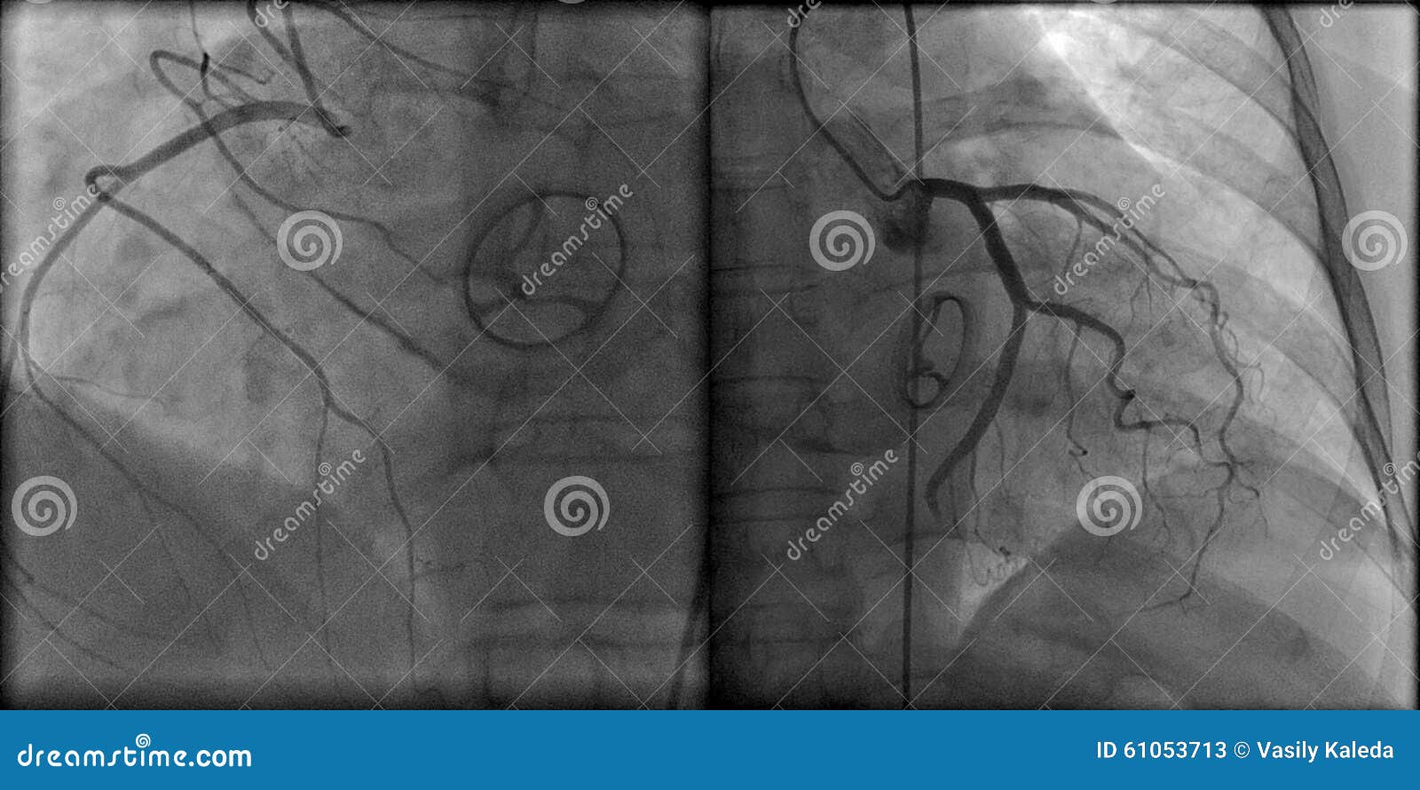 prosthetic heart valve and contrasted coronary arteries on roentgenogram
