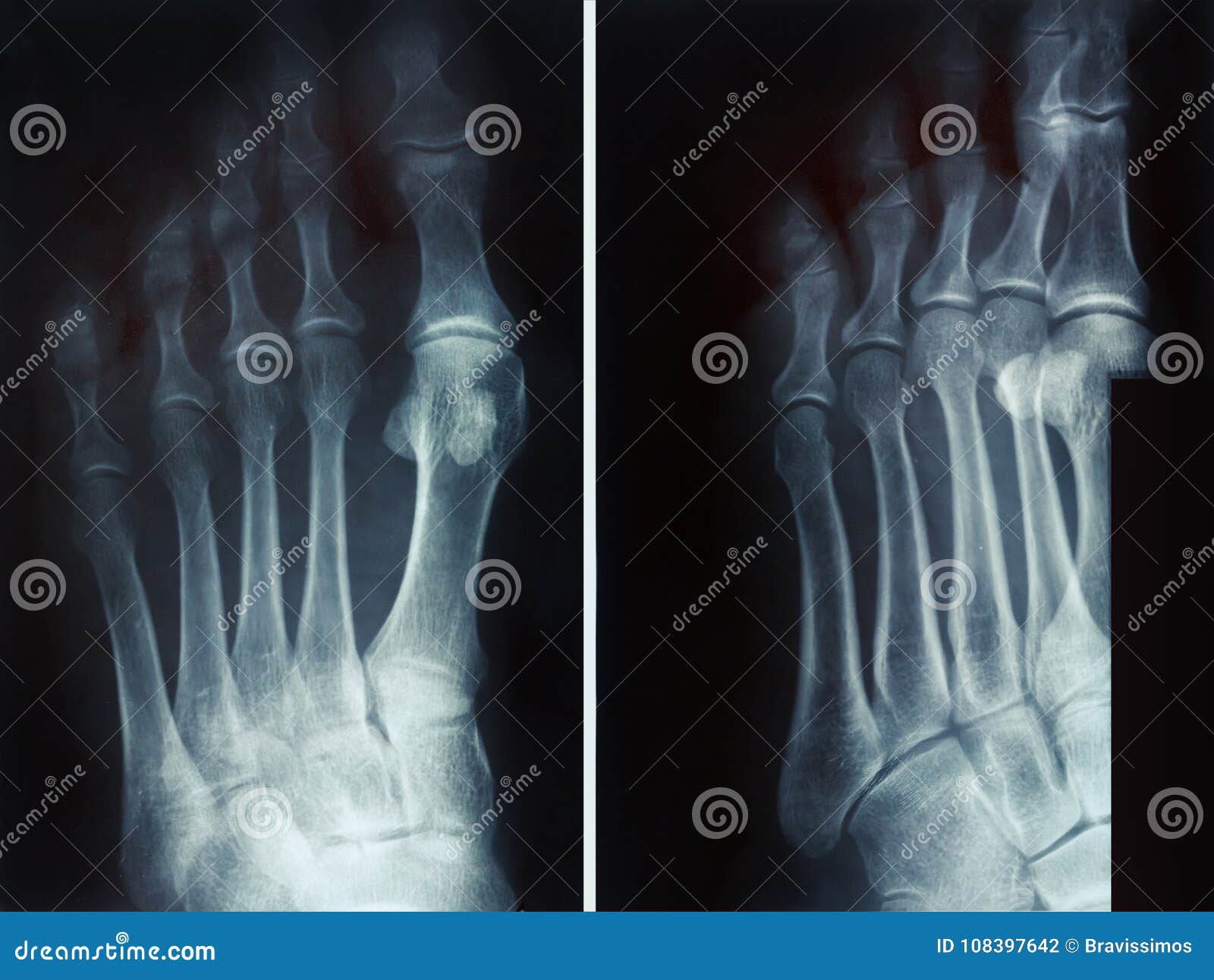 Перелом основания фаланги 1 пальца левой стопы рентген