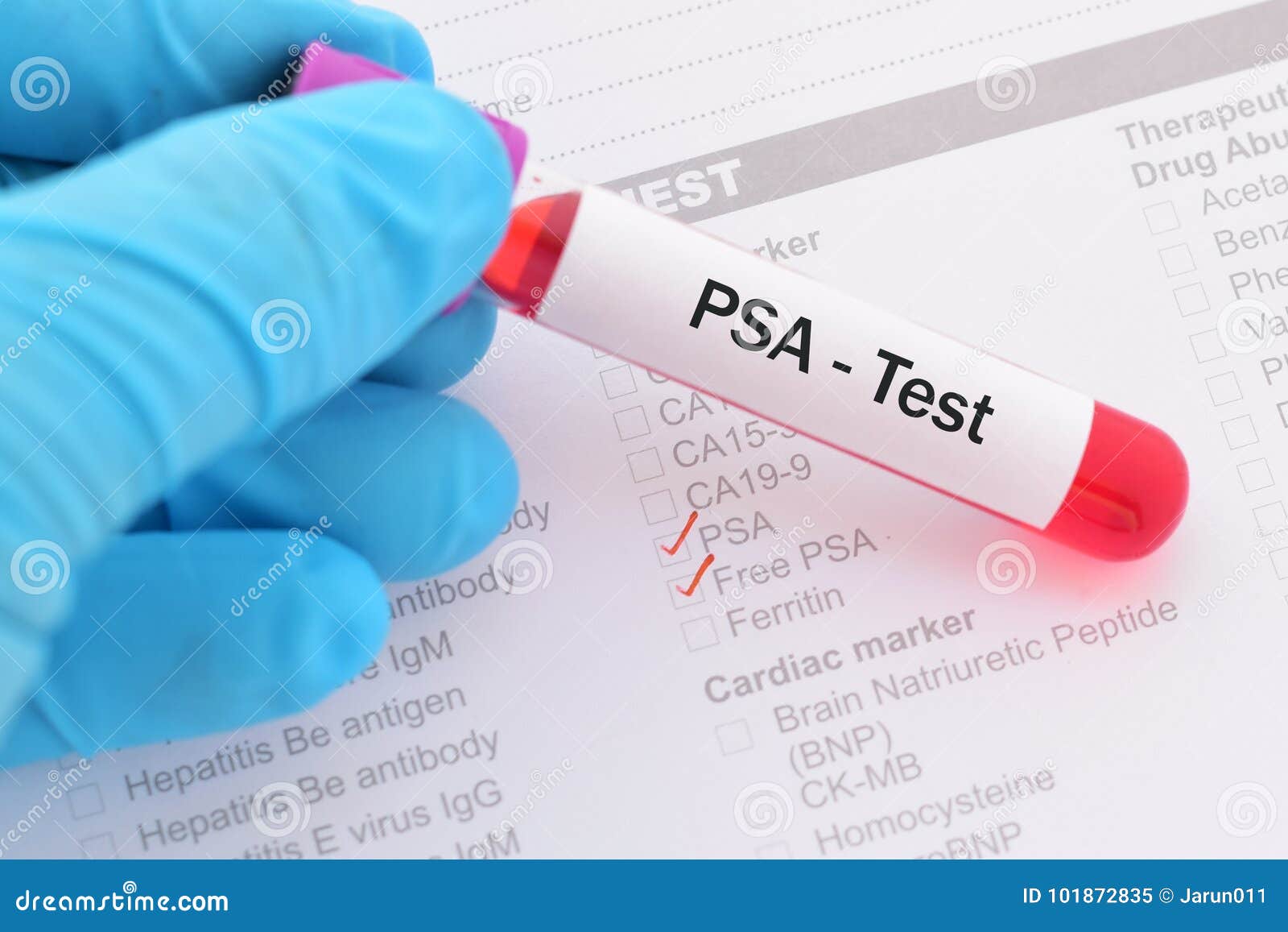 prostate cancer test blood)