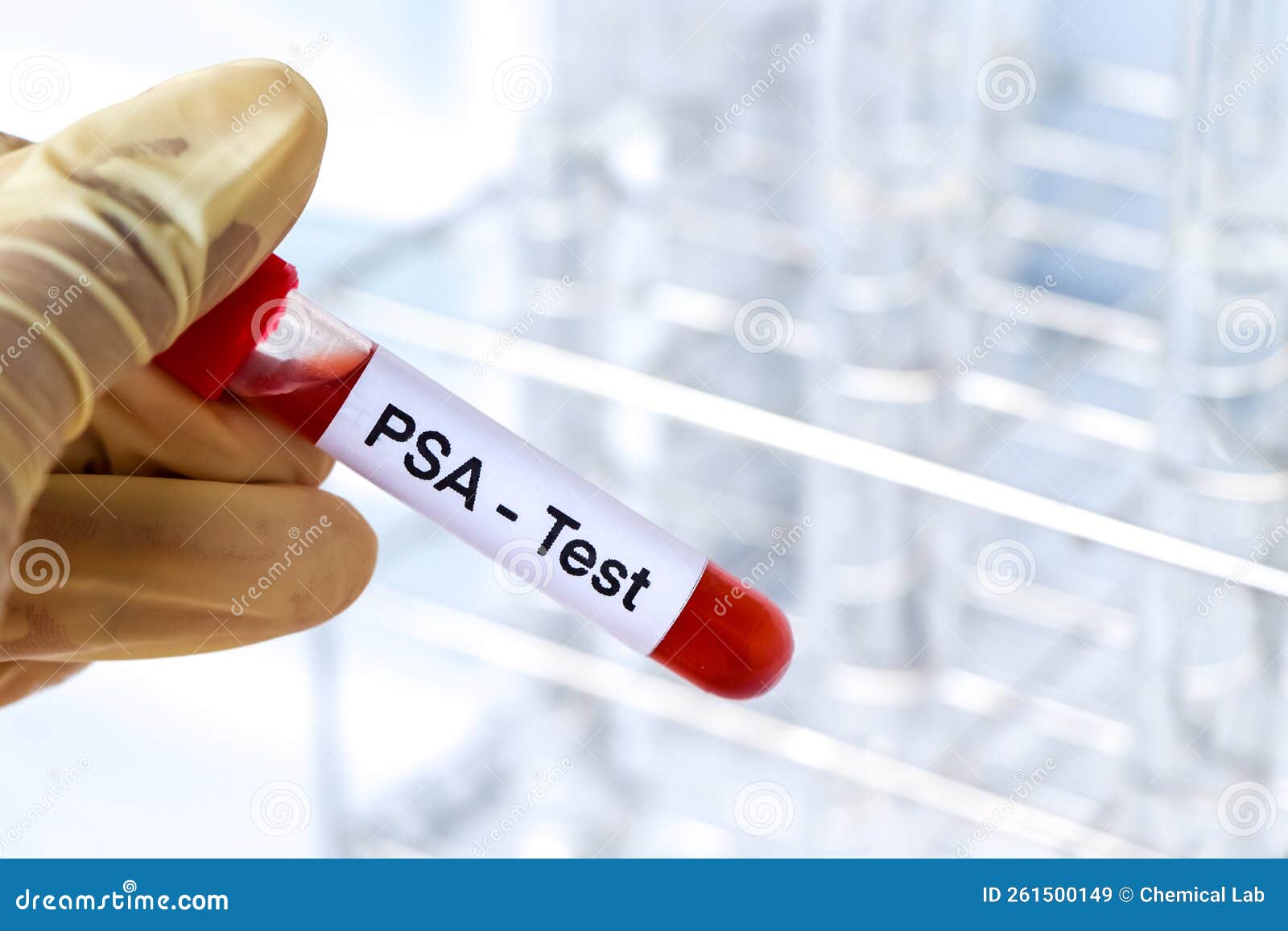 PSA Test To Look for Abnormalities from Blood Stock Image - Image of ...