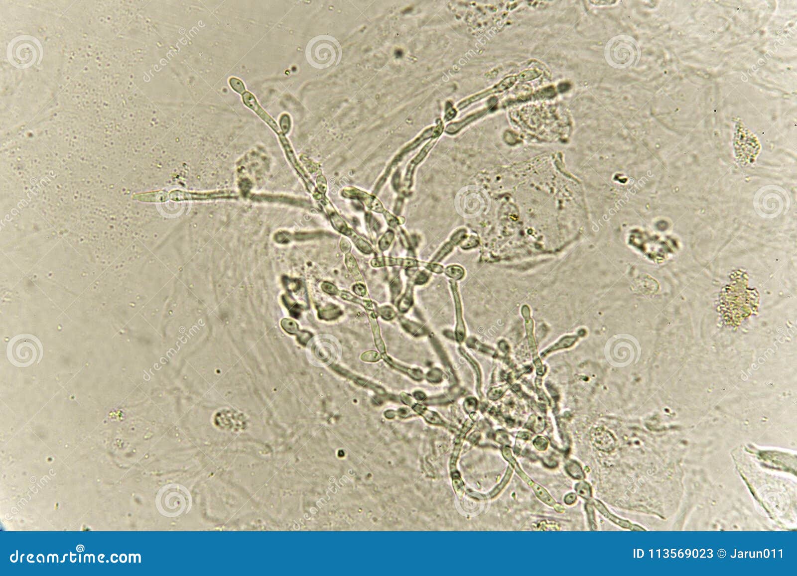 Pseudohyphae And Budding Yeast Cells In Patient Urine Stock Image