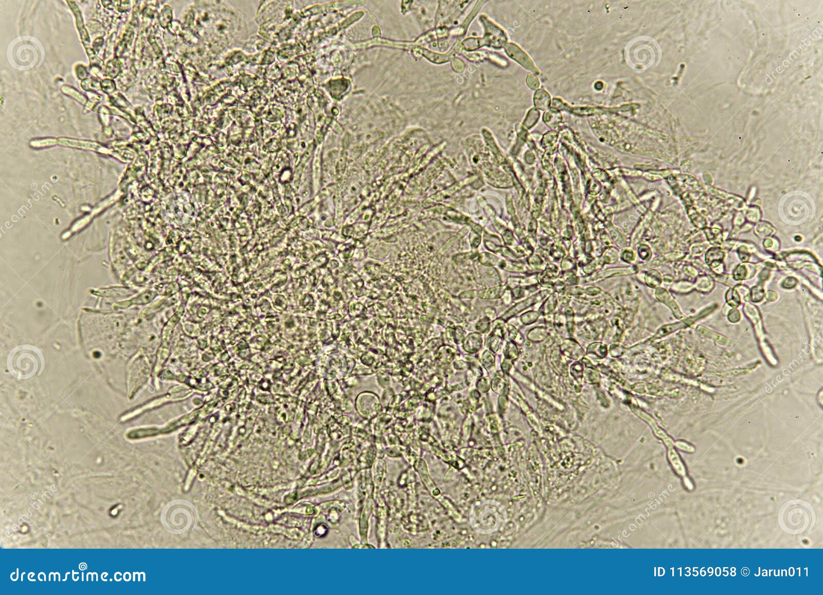 pseudohyphae and budding yeast cells in patient urine
