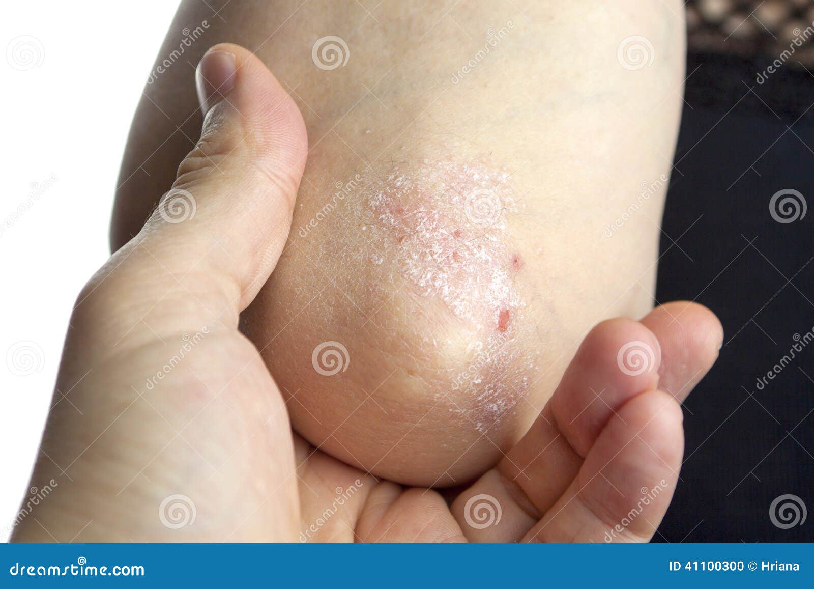 Medicinale significa per cura di psoriasi